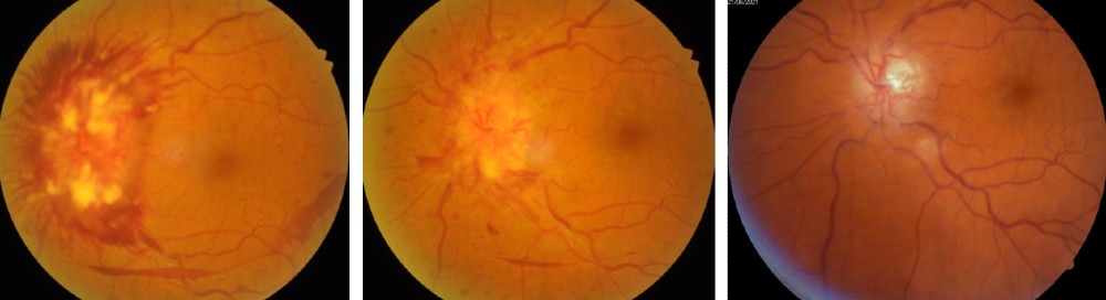 Acute NAION Ischemic Optic Neuropathy
