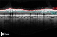 Healthy optic nerve. OCT scan Restore Vision Clinic 
