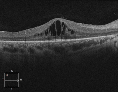 Retinitis Pigmentosa Cystoid Macular Edema retinal complications