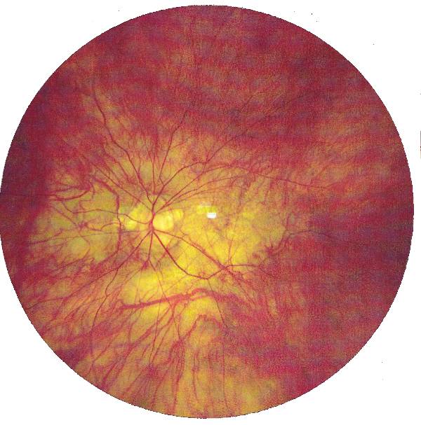 Congenital Stationary Night Blindness (CSNB) OCT exam Restore Vision Clinic 