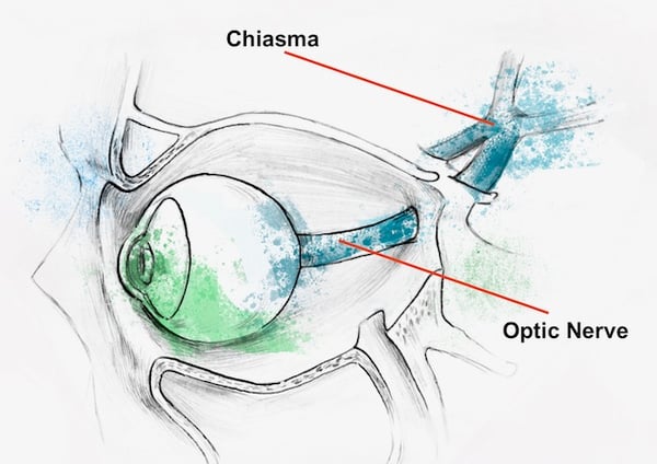 EYE OPTIC NERVE CHIASMA FEDOROV RESTORE VISION CLINIC