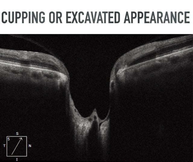 Glaucomatous cupping  excavated appearance optic nerve damage