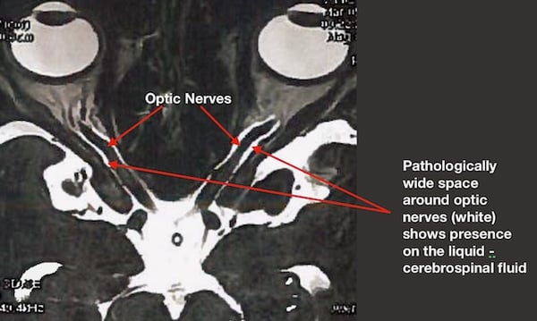 IDIOPATHIC INTRACRANIAL HYPERTENSION BRAIN IMAGING MRI CT OPTIC NERVE DAMAGE RESTORE VISION CLINIC