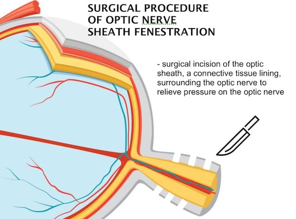 IDIOPATHIC INTRACRANIAL HYPERTENSION OPTIC NERVE FENESTRATION SURGERY RESTORE VISION CLINIC BERLIN