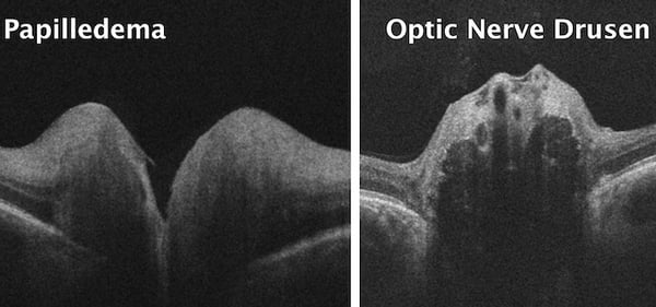 IDIOPATHIC INTRACRANIAL HYPERTENSION PAPILLEDEMA DRUSEN RESTORE VISION CLINIC