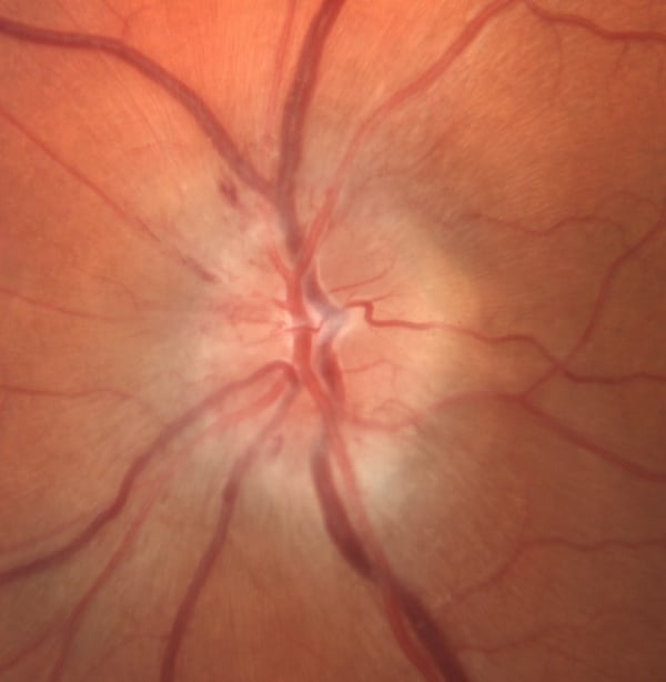 Normal Retina vs. Papilledema - Trial Exhibits Inc.