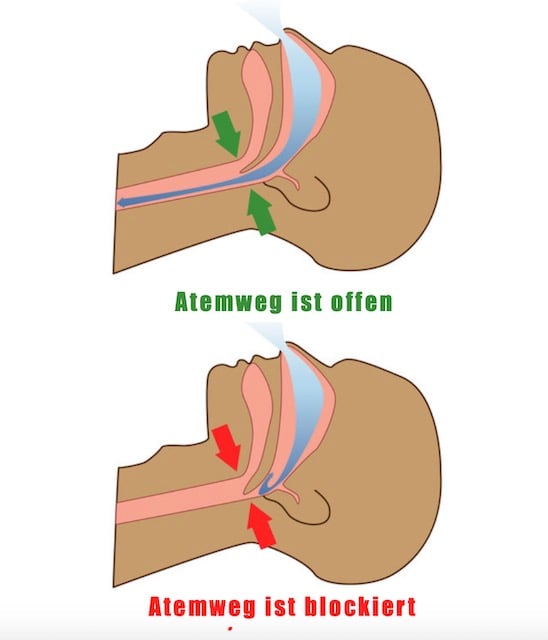 Obstruktive Schlafapnoe Physiologie Sehnerv Sehvermögen