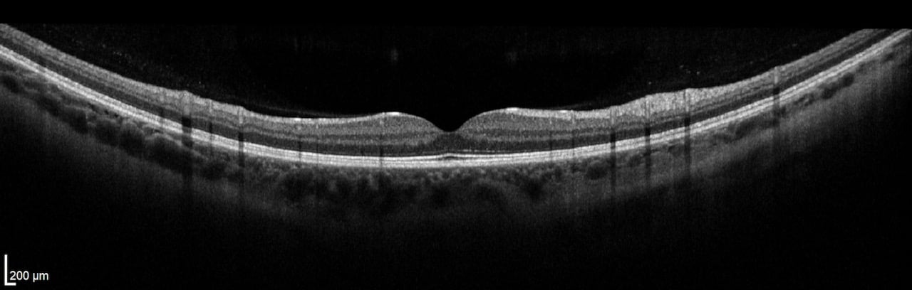 OCT examination healthy retina. Retinal cells