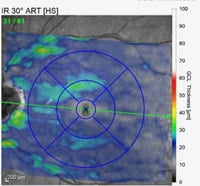 Severe ischemic optic neuropathy (NAION) Fedorov Restore Vision Clinic 