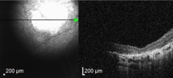 Leber Congenital Amaurosis OCT cross sectional scans may demonstrate abnormal retinal architecture