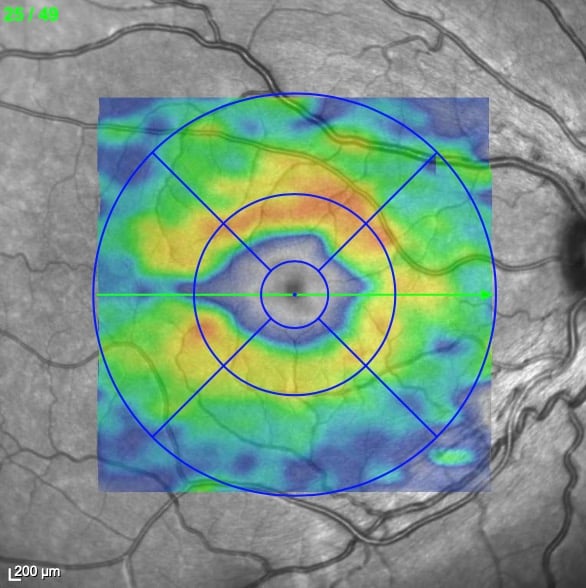 Hereditary degeneration of the optic nerve