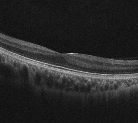 Autosomal Dominant Optic Atrophy (ADOA)