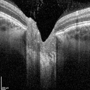 Severe optic nerve atrophy caused by ischemic optic neuropathy. NAION Fedorov Restore Vision Clinic 