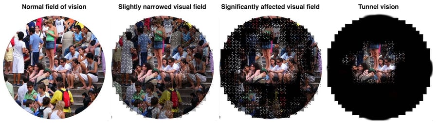 Visual Field affected by Retinitis  Pigmentosa Narrow VF tunnel vision