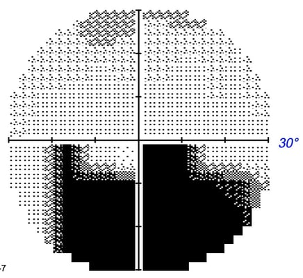 NAION. Risk of Recurrence of the Affected Eye