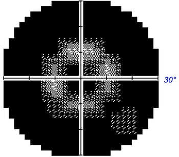 Central Field of Vision affected by Retinitis  Pigmentosa central scotoma Restore Vision Clinic 