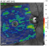 OCT complete  atrophy of retinal ganglion cells traumatic optic neuropathy
