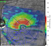 OCT half atrophy of retinal ganglion cells by ischemic optic neuropathy
