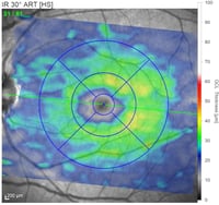 OCT moderate  atrophy of retinal ganglion cells Leber Hereditary Optic Neuropathy