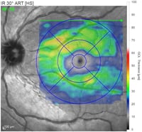 OCT moderate  atrophy of retinal ganglion cells optic neuritis