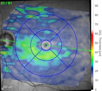 OCT severily atrophied  retinal ganglion cells by glaucoma