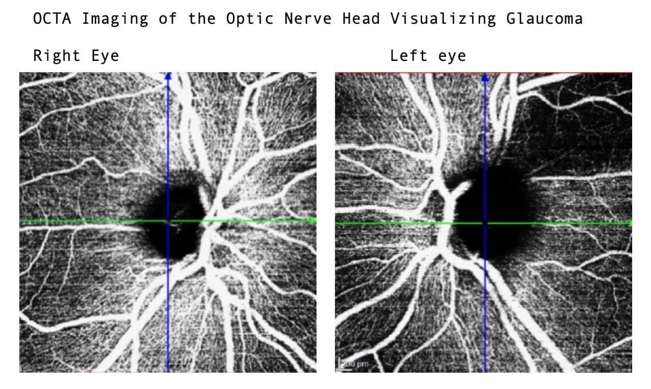 OCTA Optic Nerve Head Imaging for Glaucoma Detection Fedorov Restore Vision Clinic 
