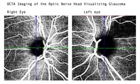 Early Detection of Glaucoma with OCTA: A Game-Changer in Vision Preservation - Featured Image