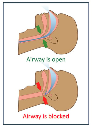 Obstructive Sleep Apnea and Ischemic Optic Neuropathy