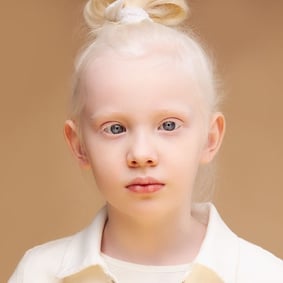 Medical Breakthrough: How Doctors Are Improving Vision in Ocular Albinism Patients - Featured Image