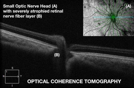 Optic Nerve Hypoplasia  OPTICAL COHERENCE TOMOGRAPHY Fedorov Restore Vision Clinic 