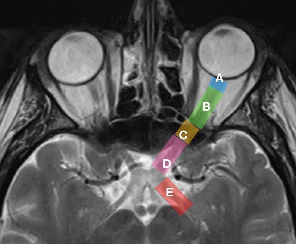 Optic nerve structure parts Fedorov Restore Vision Clinic 