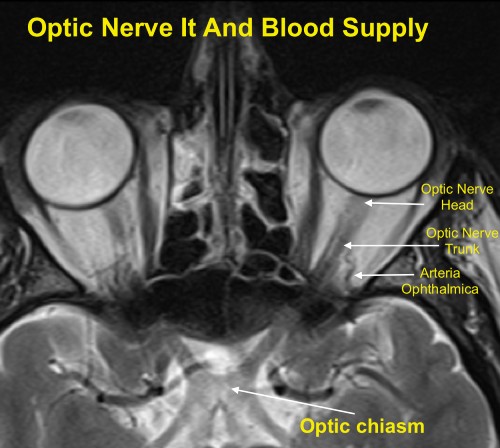 Pathogenesis of NAION. Optic nerve blood supply
