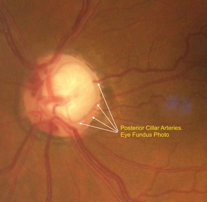 Posterior Cillar Artery Fundus Photo
