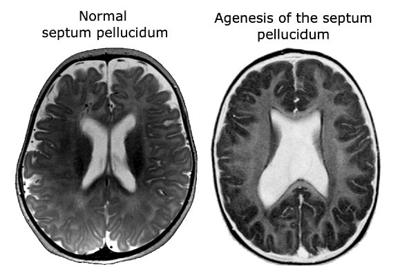 Septo-optic dysplasia agenesis of the septum pellucidum and_or corpus callosum