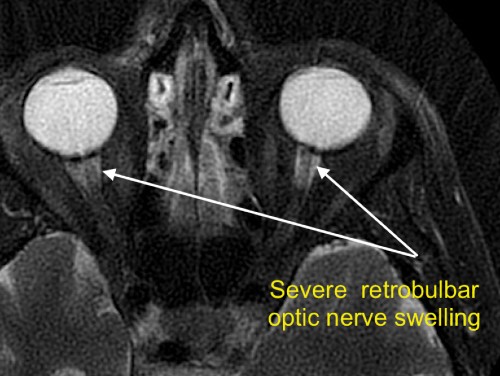 Severe retrobulbar optic nerve swelling due to NAION