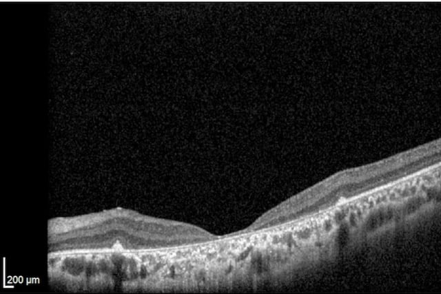 OCT Cone Dystrophy Stargardt Disease