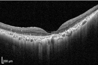 OCT Retinitis Pigmentosa. Advanced stage Cone Rod Dystrophy Severe cone atrophy