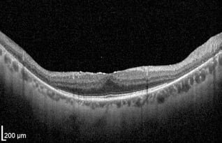 OCT Retinitis Pigmentosa. Advanced stage Rod-Cone Dystrophy Fedorov Restoration Therapy
