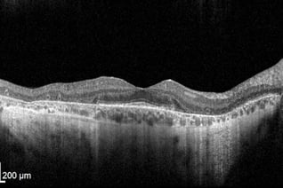 OCT Retinitis Pigmentosa. Advanced stage Severe rod atrophy Retinal RPE retinal pigment epithelium atrophy