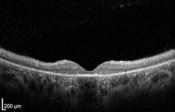 OCT Retinitis Pigmentosa. Severe stage Rod Dystrophy Fedorov Restore Vision Clinic