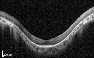 OCT Retinitis Pigmentosa. moderate stage Rod Dystrophy Restore Vision Clinic Germany