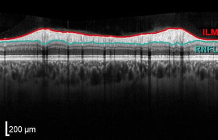 OCT Temporal optic nerve atrophy leber hereditary optic neuropathy Fedorov Restore Vision Clinic