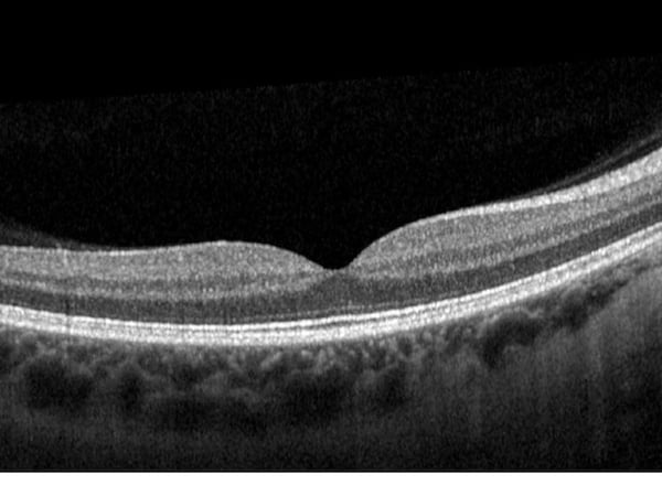 OCT healthy retina