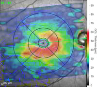 OCT inital  atrophy ofretinal ganglion cells glaucoma