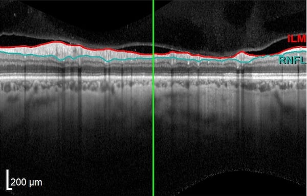 OCT mild optic nerve damage13