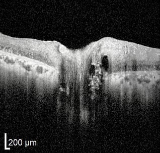 OCT scan over optic nerve head with inintial drusen