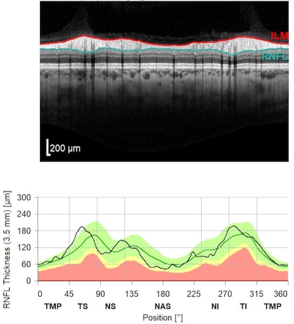 OCT undamaged optic nerve and thickness map