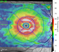 OCT undamaged retina retinal ganglion cells mapping