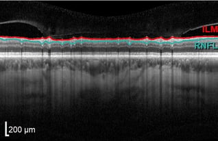 Severe optic nerve atrophy