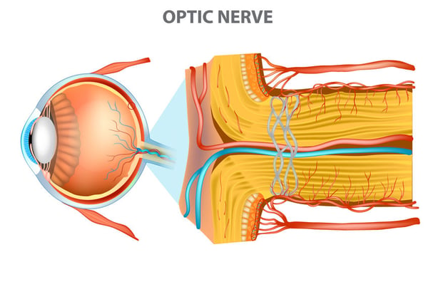 ischemic optic neuropathy ischemia anterior portion optic nerve Sleep Apnea 